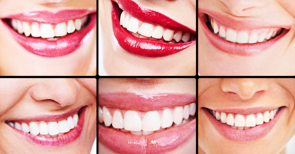 What Are The Differences Between Composite Resin Bonding & Veneers?